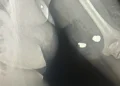 Balas ficaram alojadas no braço da vítima. Foto: Reprodução da Internet