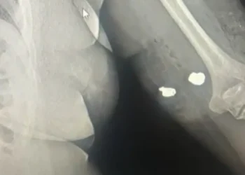 Balas ficaram alojadas no braço da vítima. Foto: Reprodução da Internet