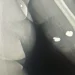 Balas ficaram alojadas no braço da vítima. Foto: Reprodução da Internet